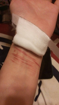 リストカットの傷跡を目立たなくなるするためには何が一番いいでしょうか Yahoo 知恵袋