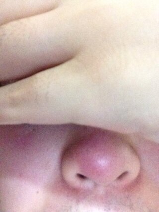 鼻 てっぺん 赤い 痛い 鼻 てっぺん 赤い 痛い