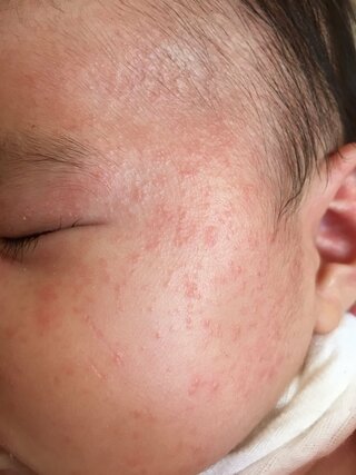 乳児湿疹について 現在3ヶ月なのですが先週あたりからおデコに赤いブツブ Yahoo 知恵袋