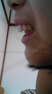 出っ歯の女の子は恋愛対象になりますか 大学生処女です Yahoo 知恵袋