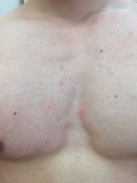 この胸の発疹はHIVか梅毒の症状ですか？ - 梅毒はバラ疹といって手の 