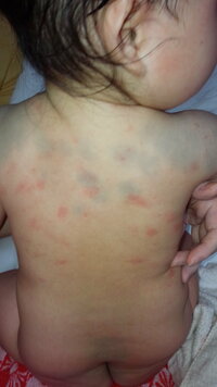 お風呂上がりは特に目立つのですが背中のこの赤いのは 乳児湿疹ですか 顔のブツブ Yahoo 知恵袋