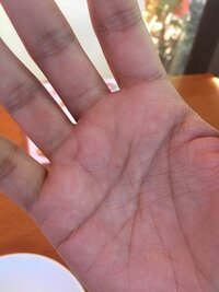 右手薬指に輪ができました 調べると太陽環とありましたがこれは本当に太陽 Yahoo 知恵袋