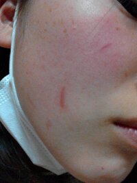 顔の傷跡を治すにはどうしたらいいでしょうか 本当にコンプレッ Yahoo 知恵袋
