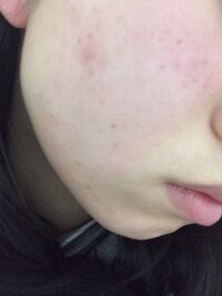 ニキビニキビ跡 皮膚科にもいっても治らない ニキビ跡がまだで Yahoo 知恵袋