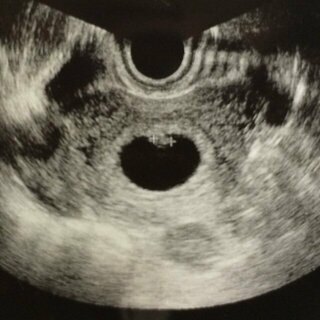 胎芽の大きさについて エコー写真あります 現在7週3日になる妊婦です Yahoo 知恵袋
