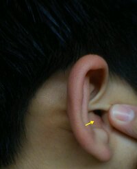 なんか耳の入り口のへんにしこりみたいなのができてます おすと Yahoo 知恵袋