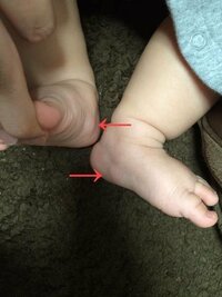 生後8ヶ月の子供の足に異様なコブ見たいのがあります。これはなんでしょうか？痛みはなさそうなのですが、心配です。 土踏まずの横あたりになります。写真添付します。よろしくお願いします