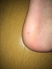 左足かかと付近にほくろ のような黒いシミを発見しました 特に痛み Yahoo 知恵袋