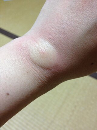 今の季節 何の虫に刺されたらこよように腫れてしまうのでしょう Yahoo 知恵袋