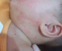 生後5ヶ月の赤ちゃんの顔に赤いできものができています食事はほとんど母乳 Yahoo 知恵袋