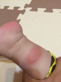赤ちゃんの虫刺され について 身体に画像のようなものがありました ダニな Yahoo 知恵袋