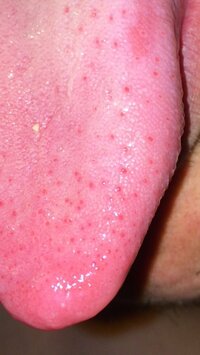 舌のこの赤い斑点はなんですか イチゴ舌では 最近 喉の痛みや微熱 Yahoo 知恵袋