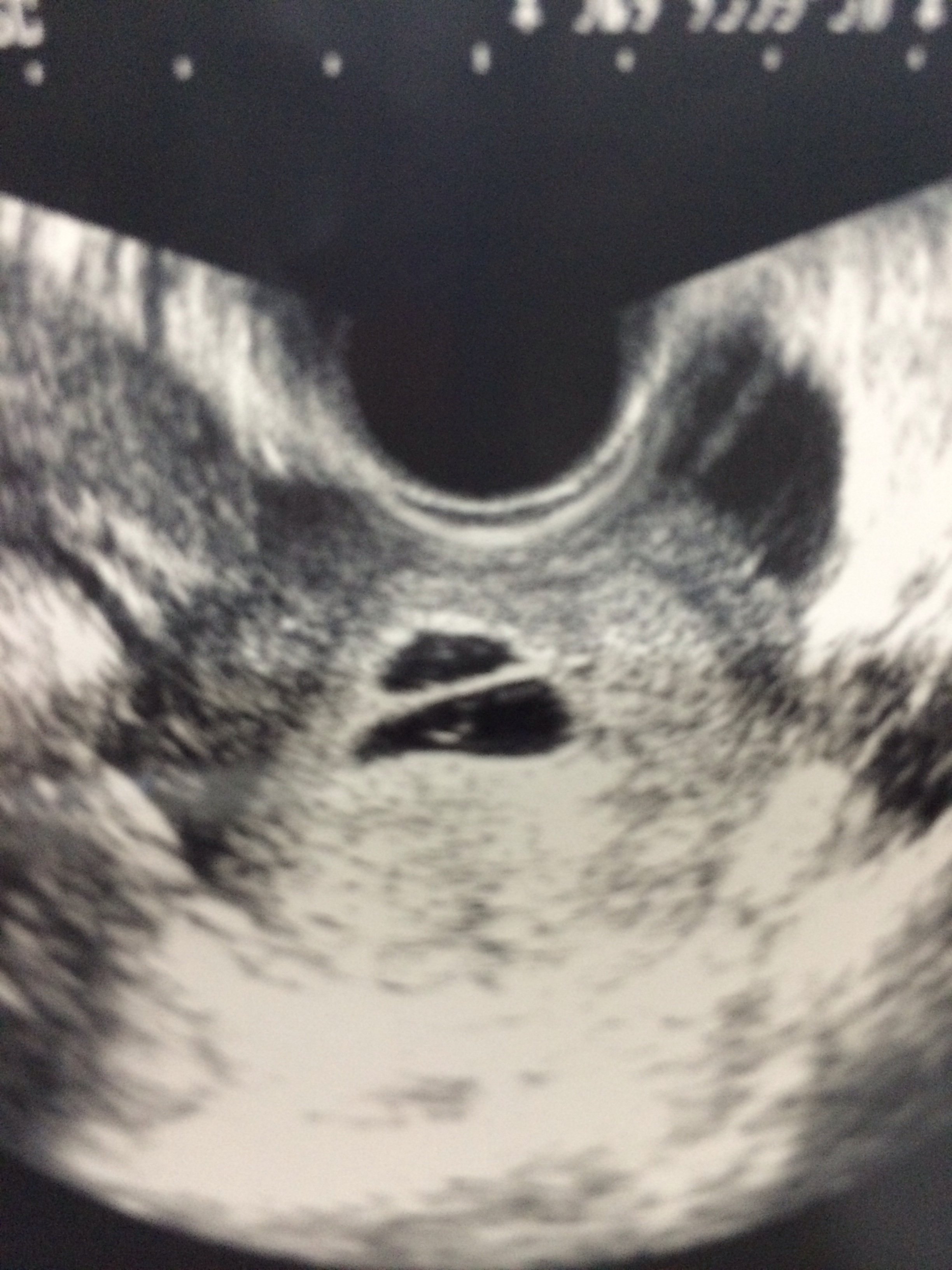 双子 妊娠初期 に関するq A Yahoo 知恵袋