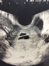 妊娠初期双子ですか 妊娠が発覚し 病院の先生には双子だと言われたのです Yahoo 知恵袋