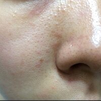 鮫肌について 治す方法を教えてください スキンケア 医療 食べ物 なんでも知 Yahoo 知恵袋