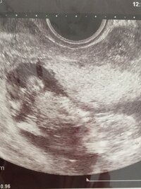 3人目妊娠中の妊婦です 12w0dの胎児エコー写真です O O 性別 Yahoo 知恵袋
