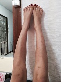 足の傷跡について 参考のためお見苦しい写真を記載しますが 見たく Yahoo 知恵袋
