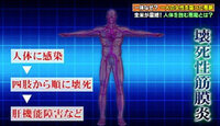 人食いバクテリア国内激増中 ３０代で突然死も ２０１０年度の Yahoo 知恵袋