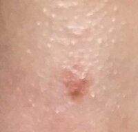 赤い傷跡について数年前に怪我をしたのですが 未だに赤くなっていて傷が残 Yahoo 知恵袋