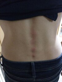 今日 お風呂上がりに背中のあざのような赤みに気づきました 背 Yahoo 知恵袋