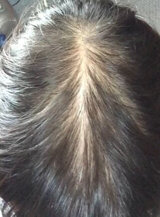 女 歳 薄毛に悩んでいます 画像あり まだ歳にも関わ Yahoo 知恵袋