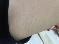内太ももに線みたいなのが数本あるのですがなんでしょうか 肉割れです Yahoo 知恵袋