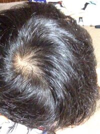 自分は中2です 周りのみんなにハゲって言われるんですけ Yahoo 知恵袋