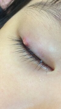 まぶたの裏に白い粒が二つ出来てしまいました これはものもらいでしょうか 痒み Yahoo 知恵袋