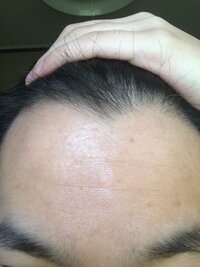 若ハゲでm字が進行しているんですが美容室とか床屋に凄く行きづらくないですか Yahoo 知恵袋
