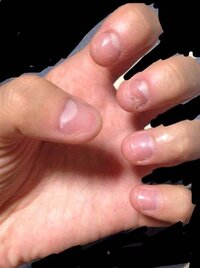 深爪を治したい 高2女子です 小さい頃から爪噛み癖があり 画像の通り汚 Yahoo 知恵袋