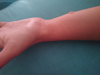 質問なのですがやけどの水ぶくれがひどいのですが こういう Yahoo 知恵袋