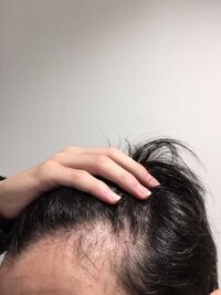 これって禿げですか 生まれつき富士額のような形でしたが左側の髪が Yahoo 知恵袋