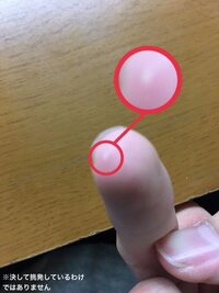 右手の中指に白い点のようなものができました 気が付いた Yahoo 知恵袋