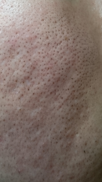肌荒れ頬の毛穴がひどいです T T 画像あり歳男性です 化粧水と乳 Yahoo 知恵袋