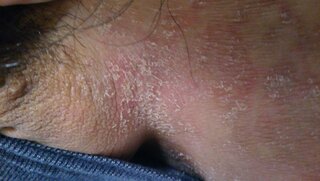 いんきんたむし うつる