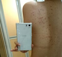 画像あり観覧注意 背中に突如大量のブツブツができました 元々ニキビ体 Yahoo 知恵袋