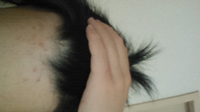 片側だけ薄い髪の毛について 私は代の男性です 以前から右側のこめかみあたり Yahoo 知恵袋