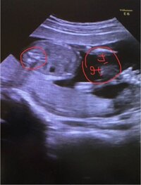 妊娠17週目のエコー写真です 丸で囲んでいる白い点３つは何なのか Yahoo 知恵袋