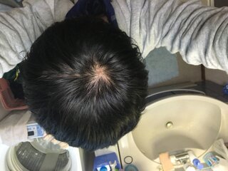 22歳の大学生なのですが 最近後頭部が薄くなった気がします ここ半 Yahoo 知恵袋