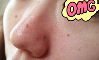 イチゴ鼻はどうやったら治りますか オロナインを使うといいですよ とか Yahoo 知恵袋