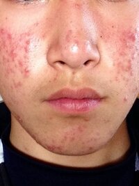 画像あり 閲覧注意 このニキビやニキビあとはどーすれば治りますか Yahoo 知恵袋