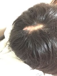 この傷の部分を手術して 傷から毛が生えてこないと医者から言わ Yahoo 知恵袋