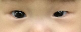 1歳4か月の娘の目の大きさが左右で違います 生まれた時から片目が Yahoo 知恵袋