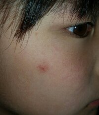 8歳の息子の頬に 赤いできもの があって気になっています 半年ほど Yahoo 知恵袋