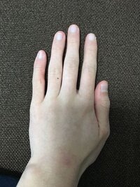 僕のコンプレックスである手の指にほくろと変な傷のようなものがあるのです Yahoo 知恵袋