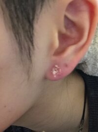 数年前に開けたピアスホールに久々にピアスをしてみたら赤く腫れ Yahoo 知恵袋