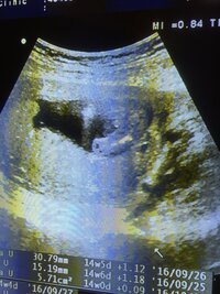 妊娠4ヶ月のエコー写真です 性別どちらか分かる方いらっしゃいますか Yahoo 知恵袋