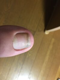 爪をいじってしまって爪が根元から剥がれてなくなってしまいました これはもう Yahoo 知恵袋