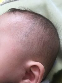 泣くと赤ちゃんの顔がまだらに赤くなります ９ヶ月の子な Yahoo 知恵袋